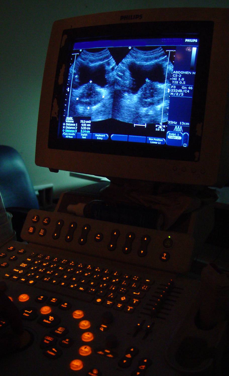 Ultrasound image of the urinary bladder (black butterfly-shaped structure) and hypertrophic ureter. An example of cooperation between practical science and medical science.