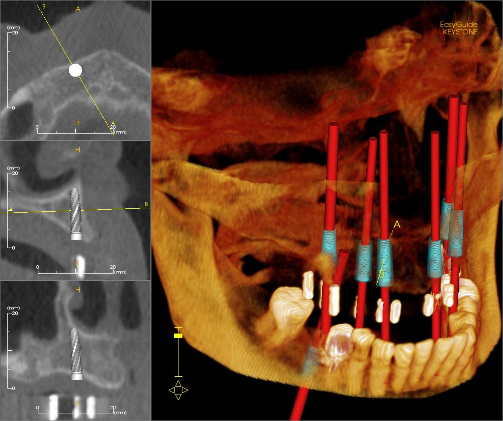 Dlaczego powierzchnia implantu jest tak ważna?